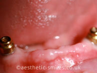 After - Smile Perfections Dental & Cosmetic Clinic