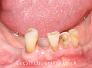 Before - Smile Perfections Dental