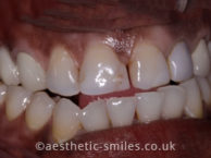 Before - Smile Perfections Dental & Cosmetic Clinic