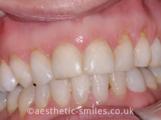 After - Smile Perfections Dental