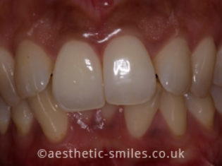 Before - Smile Perfections Dental