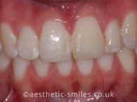 After - Smile Perfections Dental & Cosmetic Clinic
