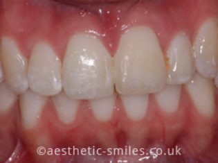 After - Smile Perfections Dental