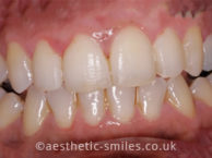 After - Smile Perfections Dental & Cosmetic Clinic