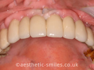 After - Smile Perfections Dental