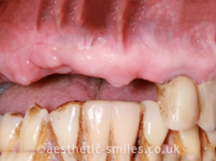 Before - Smile Perfections Dental