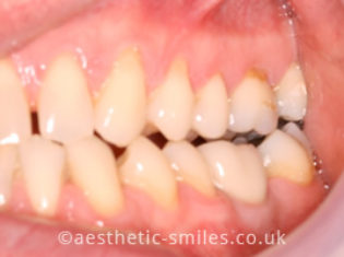 After - Smile Perfections Dental