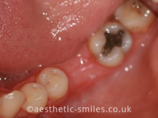 Before - Smile Perfections Dental